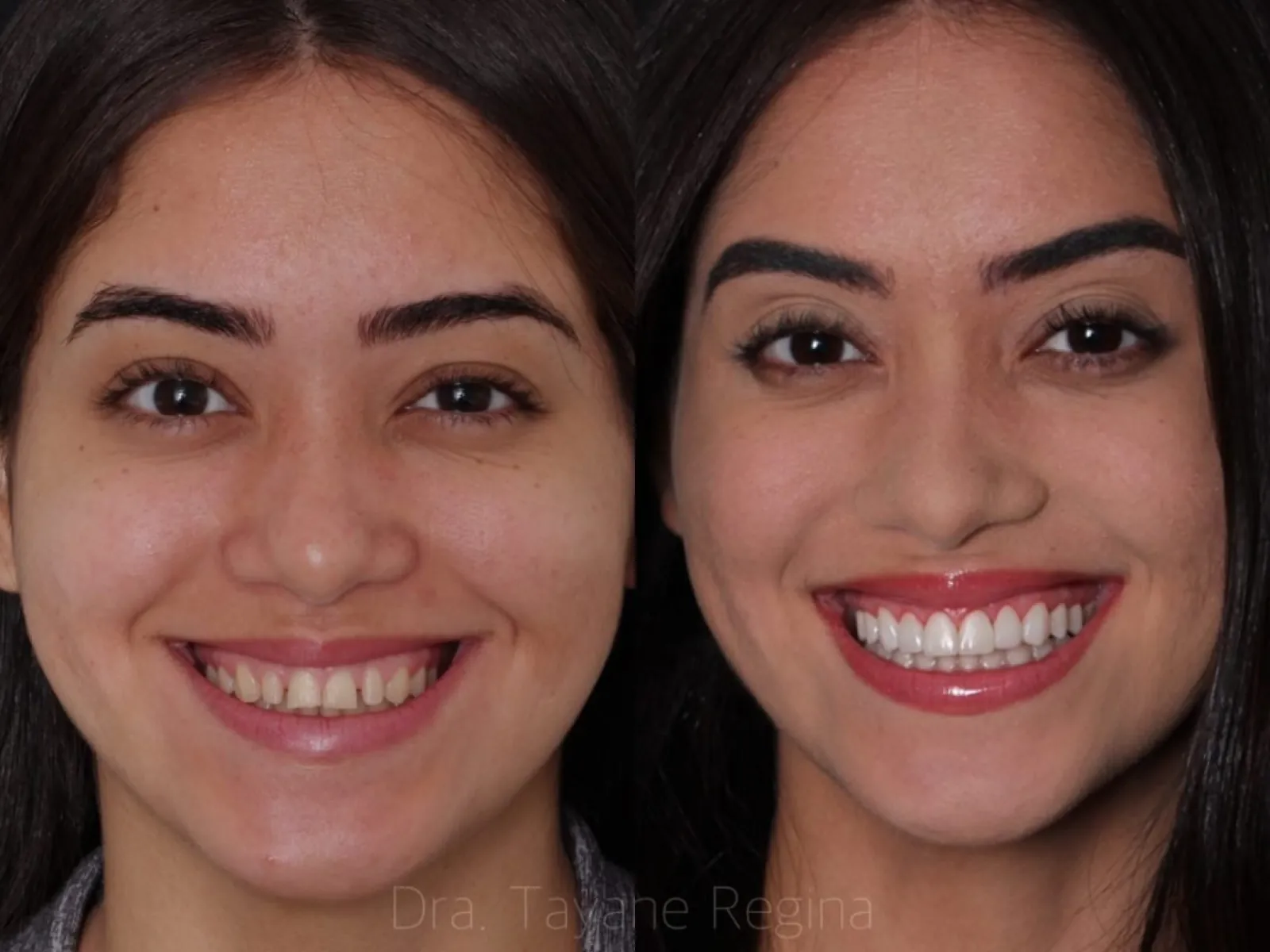 Facetas em resina na Novità